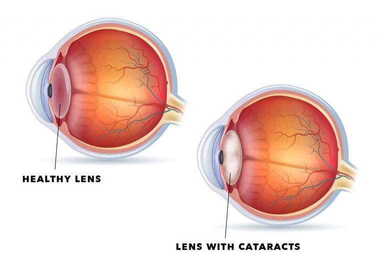 Cataracts UCHealth