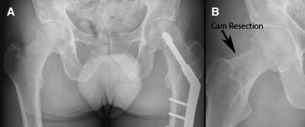 Cam Resection