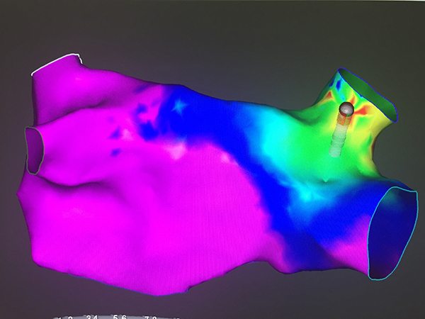 posterior view of Dennis Klinker’s left atrium