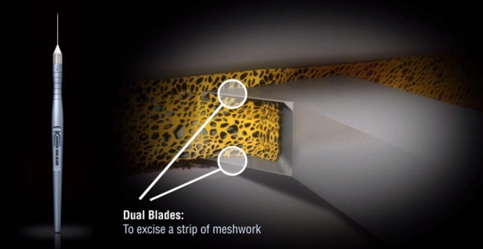 The Kahook Dual Blade