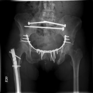 An x-ray of a badly damaged pelvis.