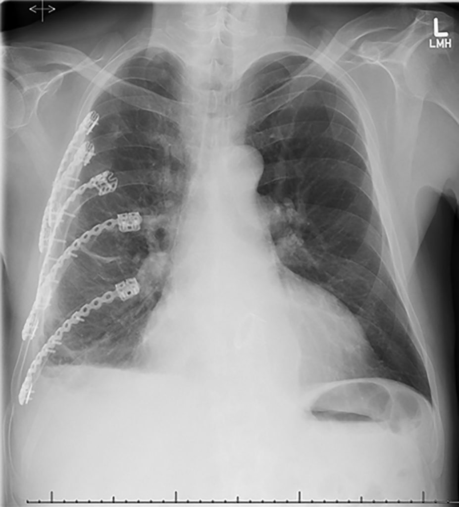 Team steps up to plate to treat injured ribs UCHealth Today