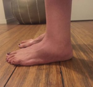 Marquez' left ankle is close to its normal size after treatment with Vicki Ralph.