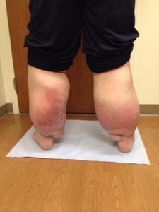 Lymphedema caused enormous swelling in Raymond Stones legs.