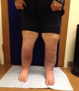 After intensive treatment with Vicki Ralph, the swelling in Stones legs subsided significantly.