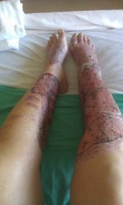 A 2011 grease fire badly burned Elaine Fowler's legs. She struggled in the aftermath, but has recovered with the help of the UCHealth Burn Center and support from peers like Shannon Kelley. Photos courtesy Elaine Fowler.