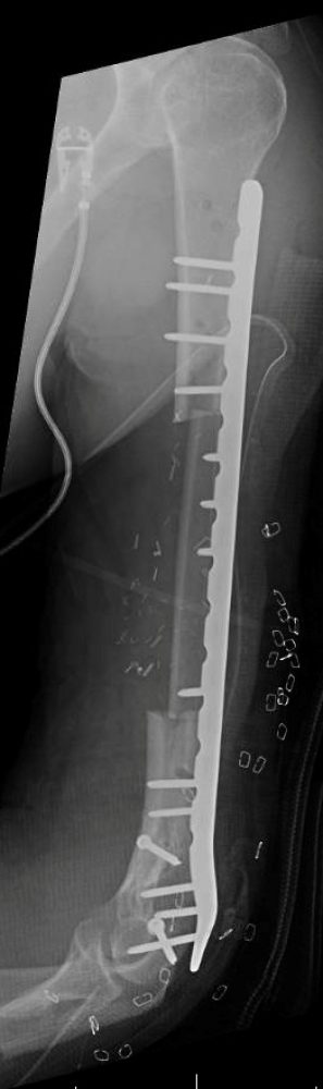 Klement’s humerus post-surgery.