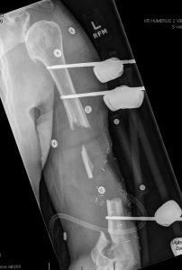 An X-ray image of Michael Klement’s left humerus