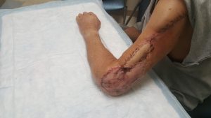 a picture of Michael Klement's reconstructed left arm after the May 5 procedure