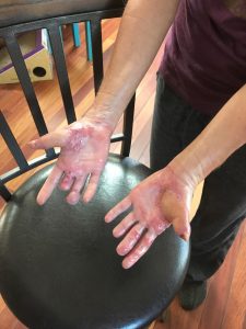 Strong's hands, shown here, after care from the Burn Center and reconstructive surgery