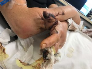 A photo of Strong's thumbs, sewn to her forearm, to connect blood vessels.