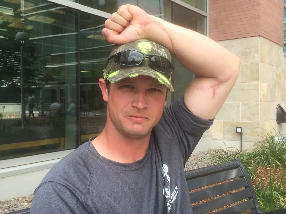 Daniel Bryce shows a healed scar on his left arm that he received from a chain saw injury.