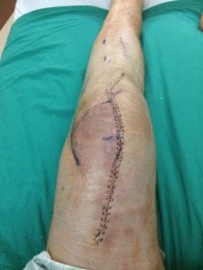 Archie Chant's leg after the distal femur replacement surgery. His leg looks really bad. It has staples from the thigh to below the knee.