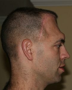 A picture of Mike Moyles that shows his indented forehead.
