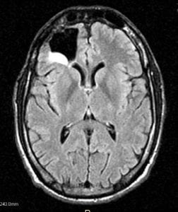 An MRI showing evidence of a brain tumor.