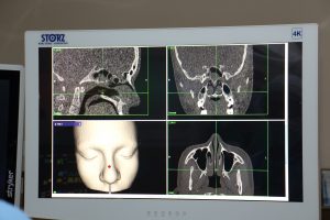 Dr. Sigmon then uses the 3D images to guide the probe, identified in the image by the dot on Kristina's nose, through the nasal cavity. Photo by UCHealth.
