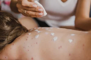 Many doctors have not seen measles since it was eradicated in the U.S. in 2000. But with new outbreaks, more doctors are caring for patients with measles, which appears as a rash, in this case on a person's back. Photo by Getty Images.