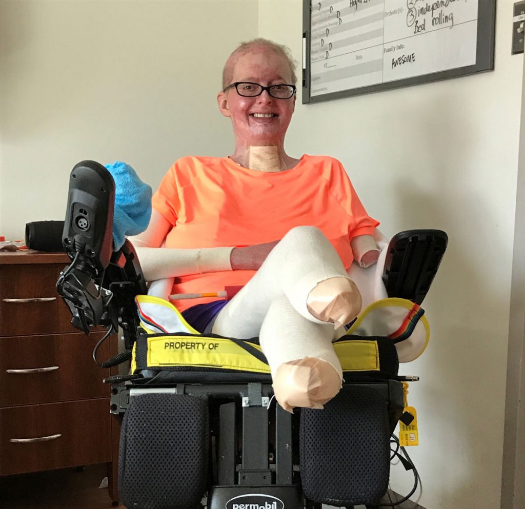 A burn survivor who lost two legs and one arm poses in her wheel chair.