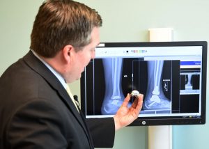 Dr. Kenneth Hunt holds a metallic copy of Deanne Carlson’s talus bone, one of three slightly different-sized versions created for her prior to her November 2018 ankle-repair surgery.