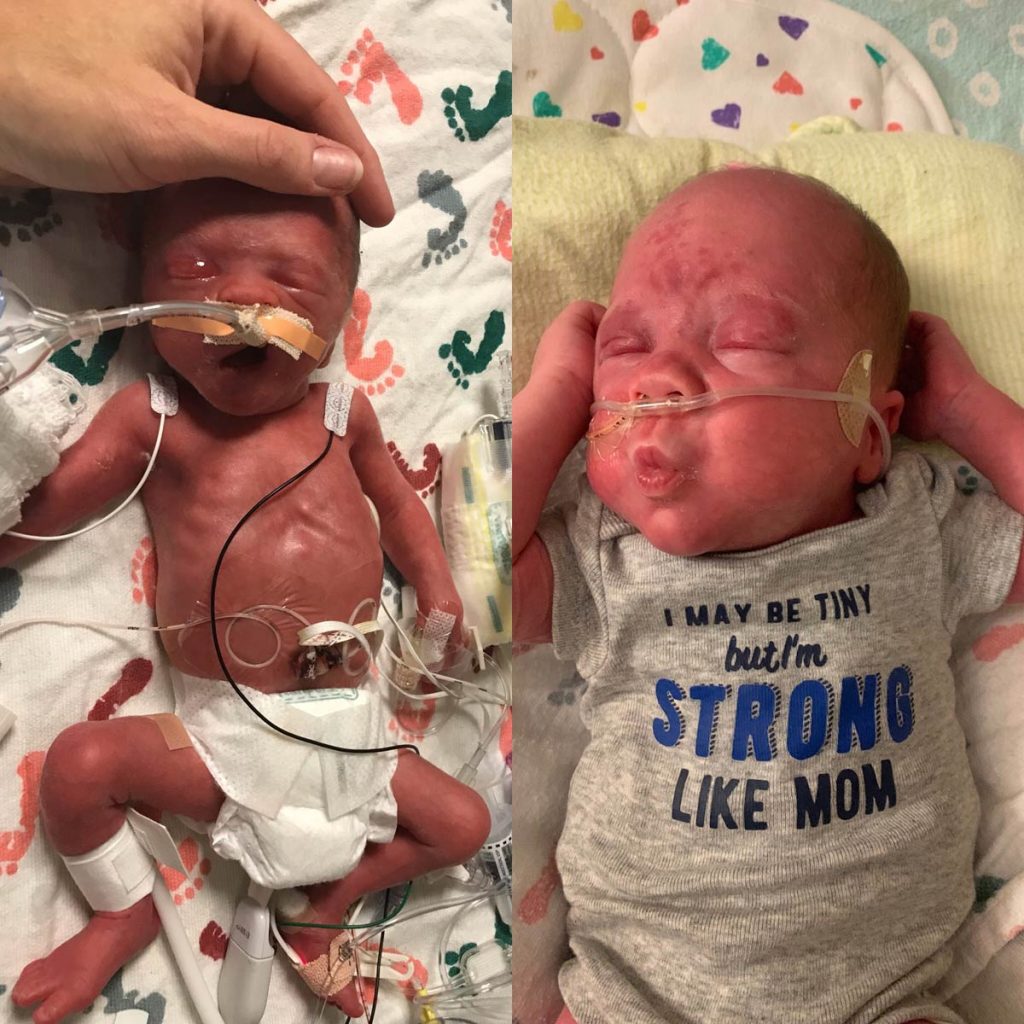 A side-by-side photo shows Lincoln right after birth and once he had reached 5 pounds, more than twice his birth weight. He seems to pucker up for kisses. Photos courtesy of Amy Jo Martin.