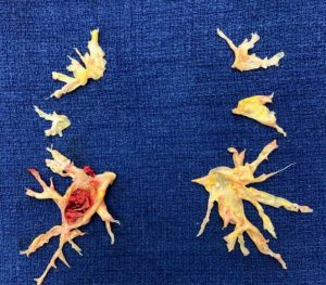 a pictuer of excised CTEPH blockages from a rare lung illness. The blockages look like bony birds