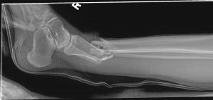 X-ray showing a fractured ankle.