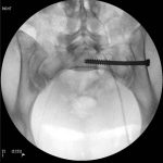 X-ray showing a large pin inserted from the hip bone into the pelvis.