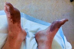 Frostbite survivor, Alec Grimes' feet. Both are purplish from frostbite.