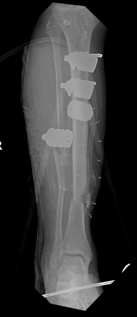 x-ray of a broken leg, as orthopedic trauma continues even with the coronavirus pandemic.
