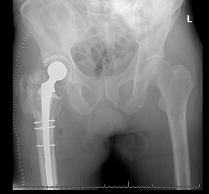 an xray of the spacer hip