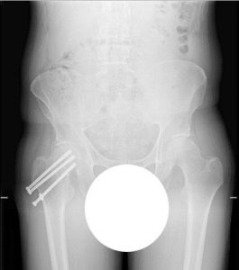 A X-ray of Haverhals’s hip on arrival at UCH that shows how the break wasn't healing and screws painful. It is the reason why a limb-lengthening surgery was needed.