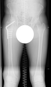 an x-ray showing how limb-lengthening surgery helped fill the gab in this man's hip.