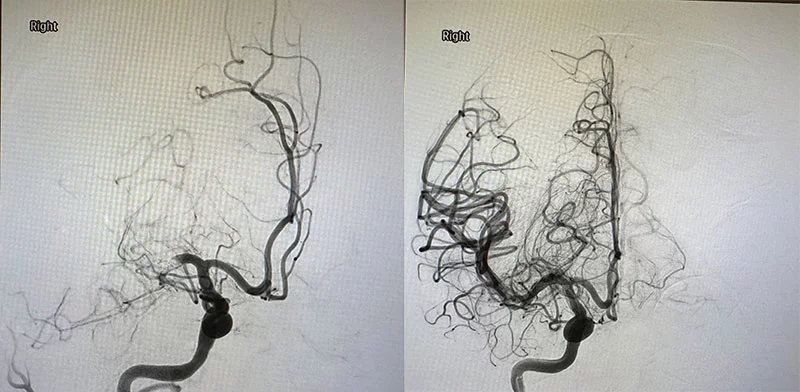 Images of the large vessels in Erica's brain before, left, and after, right, her thrombectomy. In the right image, you can see how blood flow was restored to the brain once the clot was removed. Source: UCHealth. 
