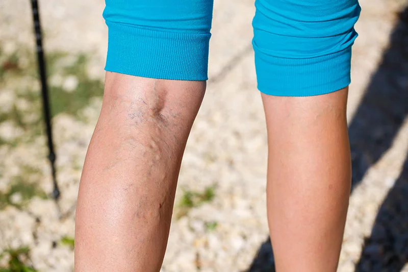 legs showing varicose veins on the back. Photo: Getty Images.