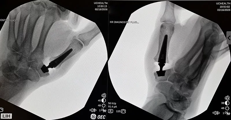 X-rays of the implant after final placement during a new thumb arthritis surgery. The first patient in Colorado and in the western U.S. received a new type of thumb prosthesis on Feb. 16 at UCHealth University of Colorado Hospital. Thumb arthritis is quite common. Hand surgeons from UCHealth and the University of Colorado Anschutz School of Medicine traveled to Europe to learn the new technique that should boost function and reduce recovery times and pain for patients. Photo by Sonya Doctorian, UCHealth.