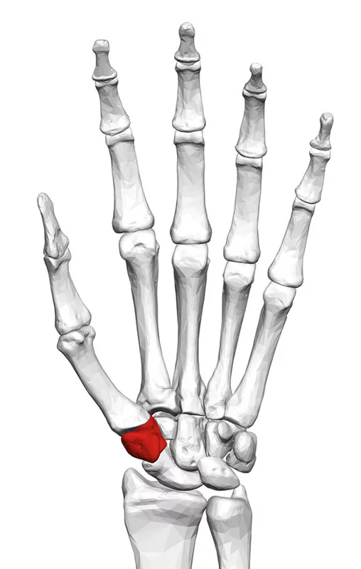 The traditional surgery to cure advanced carpometacarpal (CMC) arthritis involves removing the trapezium bone, depicted in red in the wrist bones of a left hand, with a bundle of tendon. The Touch CMC 1 prosthesis instead embeds in the bone, making for a less pain, better function, and a much faster recovery. Image via Wikimedia Commons via BodyParts3D, The Database Center for Life Science.