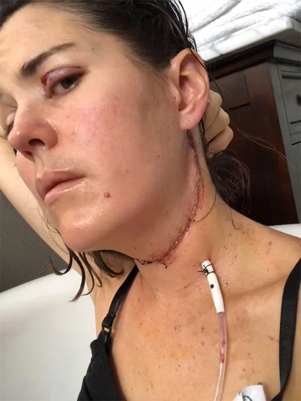 Kate shows the incision line from her surgery. Photo courtesy of Kate Showalter.