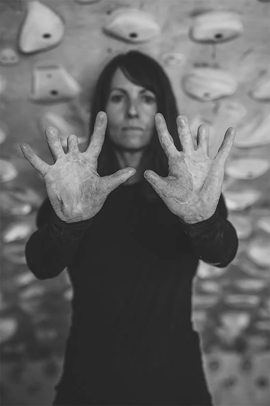 Melissa shows the damage to her hands after suffering an electrical accident. Photo by Zach Bunch, courtesy of Melissa Strong.