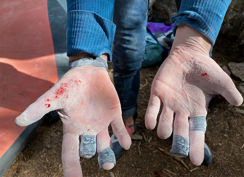 Melissa hands after climbing. Photo courtesy of Melissa Strong.